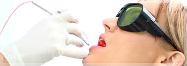 blanchiment laser dents