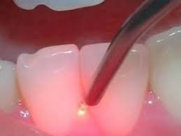 application laser au dents