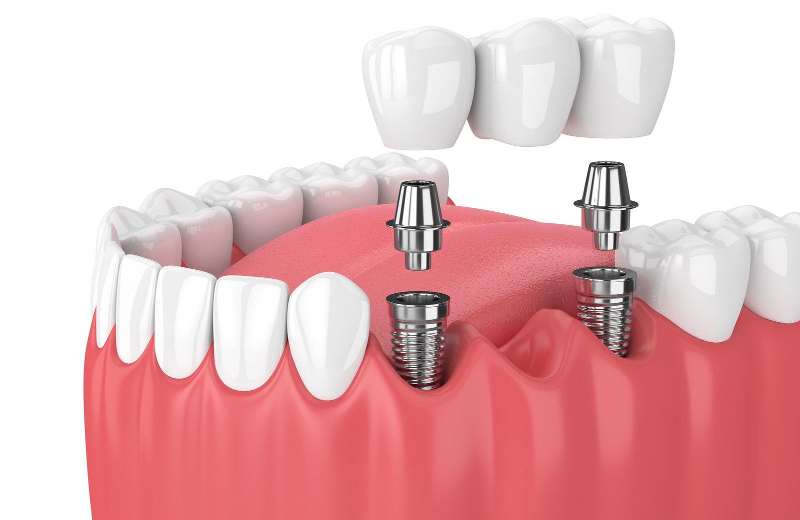 Implant Dentaire Hongrie Meilleure Destination Dentisterie Europe