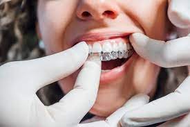 traitement dentaire invisalign