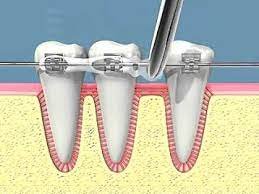 solution dent qui bouge