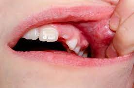 fistule gingivale ou dentaire