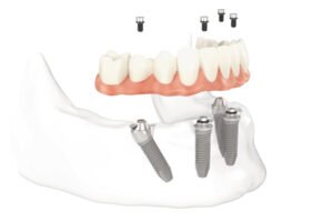 alternatives prothèse dentaire mobile