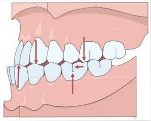 malocclusion dentaire